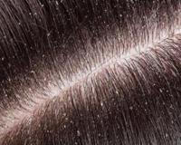 ਸਿਕਰੀ ਦੀ ਸਮੱਸਿਆ ਖ਼ਤਮ ਕਰਨ ਲਈ ਘਰੇਲੂ ਨੁਸਖ਼ ,ਲੋਕਾਂ ਨੂੰ ਕਈ ਵਾਰ ਸ਼ਰਮਿੰਦਗੀ ਦਾ ਸਾਹਮਣਾ ਵੀ ਕਰਨਾ ਪੈਂਦਾ ਹੈ